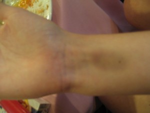 Bruised from frisbee ... will I ever be the same again?!